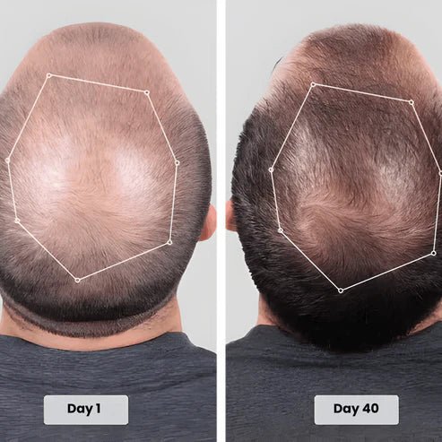 Red Light Therapy Cap for Hair Regrowth Treatments