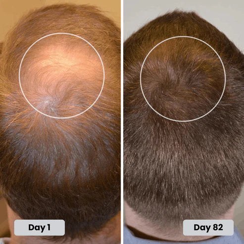 Red Light Therapy Cap for Hair Regrowth Treatments