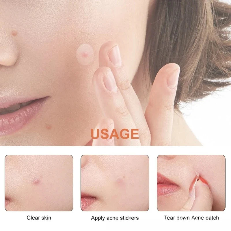 Pimple Patches