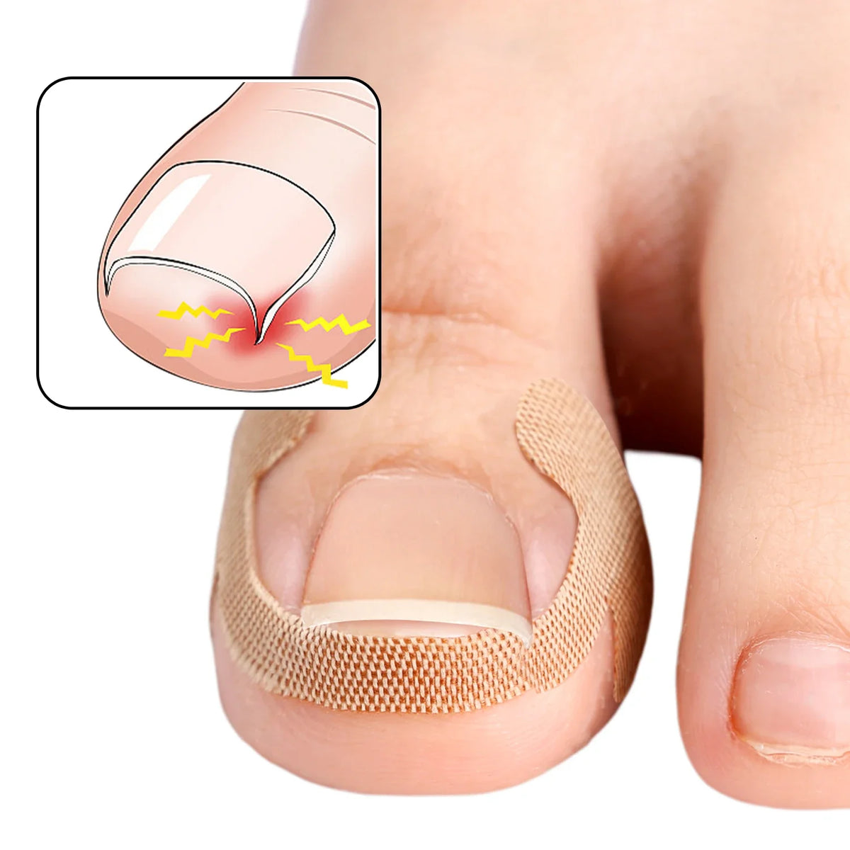 Toenail Correction Strips